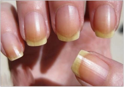 What Does Yellow Nails Mean - Nails Magazine