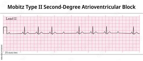 ECG Mobitz Type 2 Second Degree Atrioventricular Block - 2nd degree AV ...