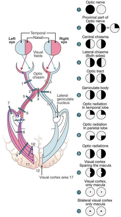 Lesions in Visual Pathway - MEDizzy