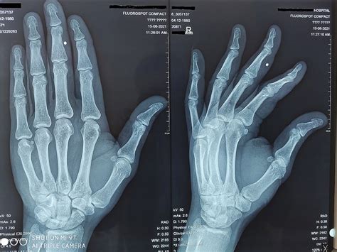 Plain X ray hand PA view shows mild subperiosteal bone resorption ...