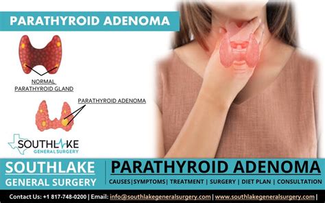 Parathyroid Adenoma – Symptoms and Treatment (Dr. Valeria Simone MD)