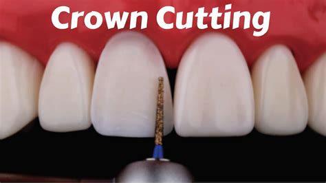 crown preparation for anterior teeth Archives - Dental Clinic