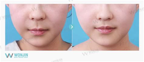 Lots of concerns about philtrum reduction?