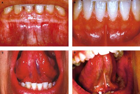 Labial Frenulum Normal