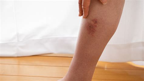 What Is Erythema Nodosum? Is It an Autoimmune Disorder? - GoodRx