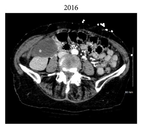 (a), (b), and (c) show computed tomography axial images of the abdomen... | Download Scientific ...