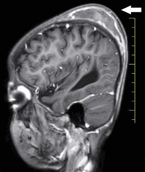 A Rare Case of a Subgaleal Hematoma With Global Developmental Delay, Scurvy, and Congenital ...