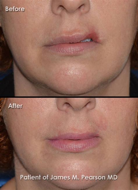 Pearson Lip Reconstructive Surgery - Before and After Photos - Dr ...