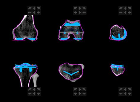 Mako Robotic-Assisted Knee or Hip Replacement. | Scan. Plan. Mako Can. | Stryker