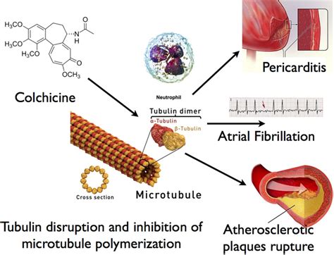 Is colchicine a promising novel treatment option for cardiovascular ...