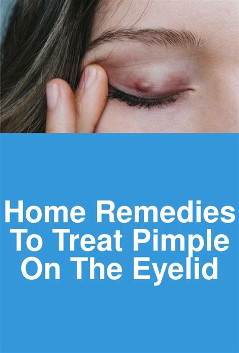 Home Remedies to Treat Pimple on the Eyelid (With images) | Pimples ...