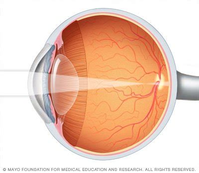 Nearsightedness Disease Reference Guide - Drugs.com