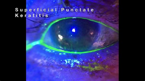 Superficial Punctate Keratitis Spk