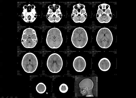 case study :: Normal CT brain :: How to report