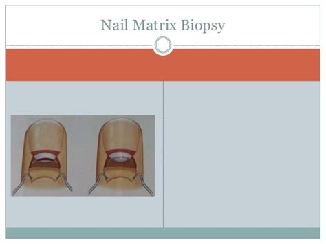 Nail biopsy