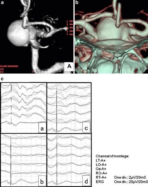 Preoperative threedimensional a left carotid angiogram and b CT... | Download Scientific Diagram