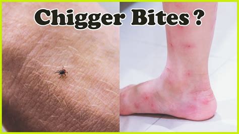 How to get rid of chiggers? – x-pest