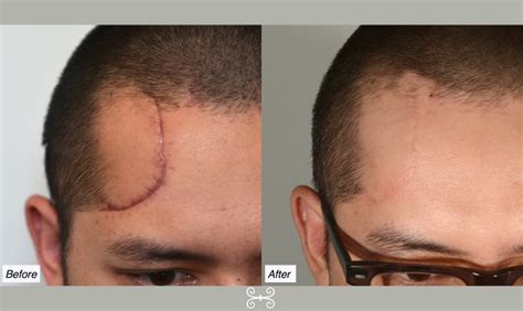 forehead scar 6months - Charleston Facial Plastic Surgery