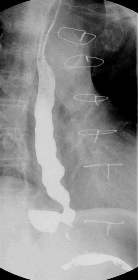 Esophageal Dysmotility