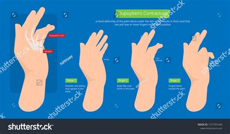 Dupuytren's contracture palm tissue disease - Royalty Free Stock Vector 1727391640 - Avopix.com