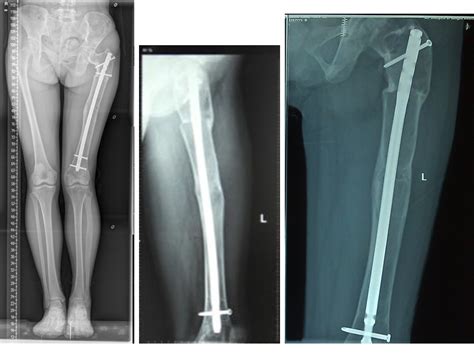 Figure 3 from Double-level osteotomy and one-stage reconstruction with long intramedullary ...