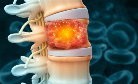 Spinal Tumors: Definitions, Causes, Symptoms, Diagnosis, Treatment, and Prognosis - Spine Info