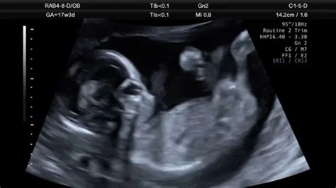 Ultrasound Scan Of 17 Week Old Fetus | Stock Video | Pond5