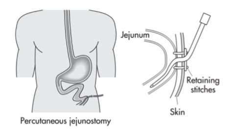 Interventional Radiology Equipment: Jejunostomy Tubes (J-Tubes) - Stepwards