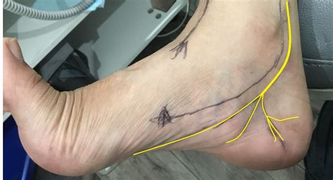 [DIAGRAM] Diagram Tibial Nerve Foot - MYDIAGRAM.ONLINE