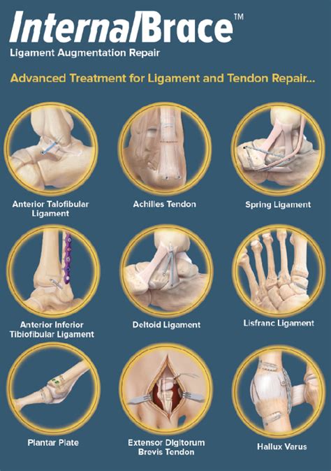 Internal Brace Fixation — Chicago Foot & Ankle Orthopaedic Surgeons