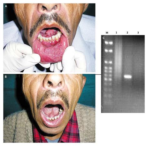 Indian Mucosal Leishmaniasis Due to Leishmania donovani Infection | NEJM