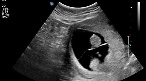 When Can Ultrasound Detect Twins?