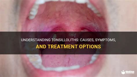 Understanding Tonsilloliths: Causes, Symptoms, And Treatment Options ...