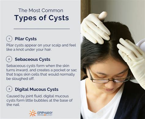 Cyst Removal | Cyst Treatment | Sebaceous Cyst Removal