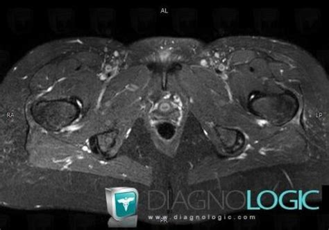 Radiology case : Enthesopathy - Tendinopathy / Pelvis (MRI) - Diagnologic