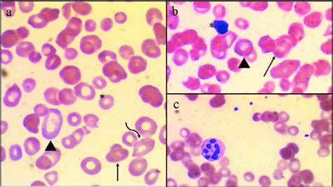 Light Microscopy of a Peripheral Blood Smear in a patient with... | Download Scientific Diagram