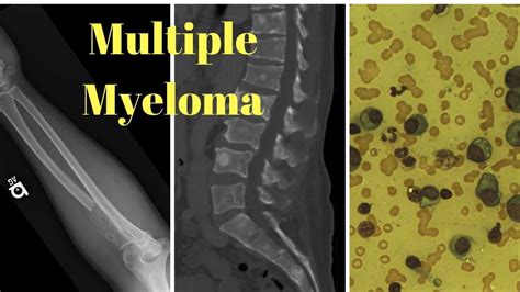 Multiple myeloma end stage – Multiple myeloma life expectancy