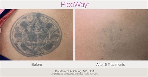 PicoWay Laser Tattoo Removal – Synergy Medical Aesthetics – Nanaimo, Victoria, Vancouver Island