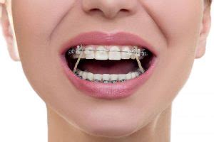 Types of Braces | Orthodontist in San Jose, CA