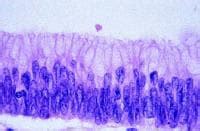 medicine in medicine: Villous Adenoma