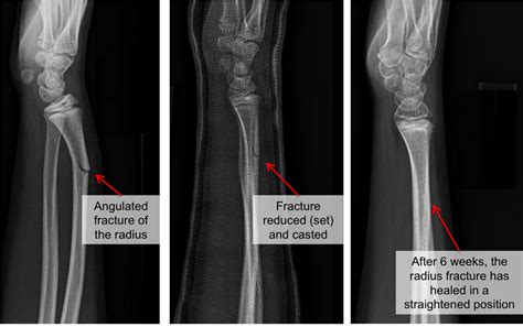 Kid's Forearm Fracture - Raleigh Hand Surgery — Joseph J. Schreiber, MD