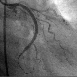 Angiogram of circumflex artery 6 months after stent deployment. | Download Scientific Diagram