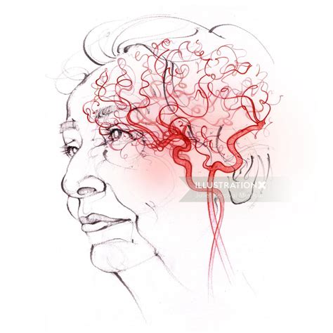 Vascular Dementia | Illustration by Juliet Percival Medical