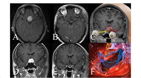 FIGURE E Resection of tuberculum sellae meningioma aided by ...