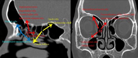 Ethmoid Anatomy