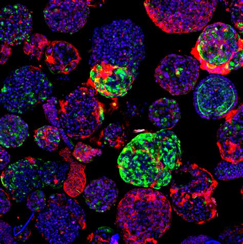 New insights into liver cancer using organoids - Hubrecht Institute