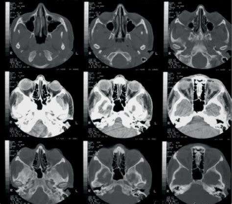 Ct scan orbit showing no signs of bone involvement, with normal ...