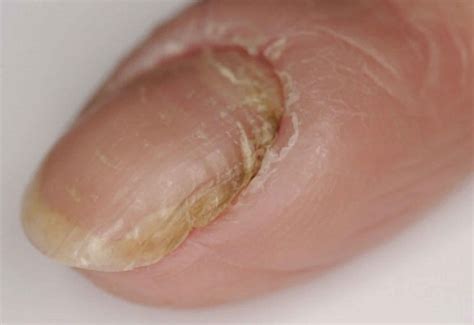 Hangnail & infected hangnail causes, symptoms, diagnosis & treatment