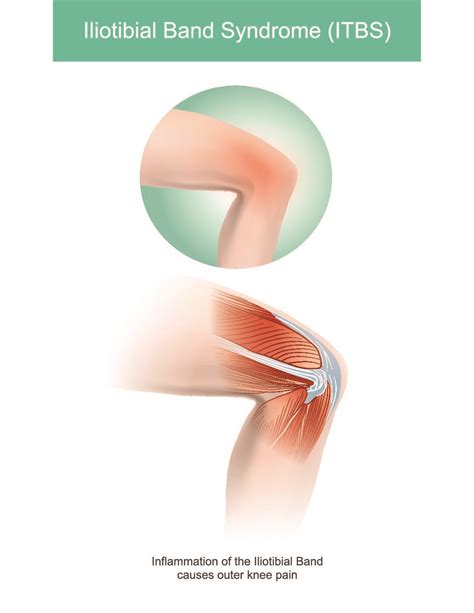 Demystifying the IT Band Syndrome | Moveo Sports and Manual Physiotherapy