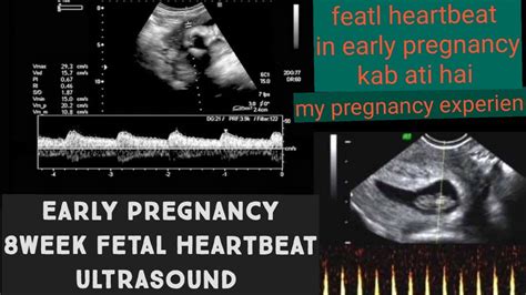 8 week fetal heartbeat ultrasound | early pregnancy ultrasound for heartbeat |kabtak ati h ...